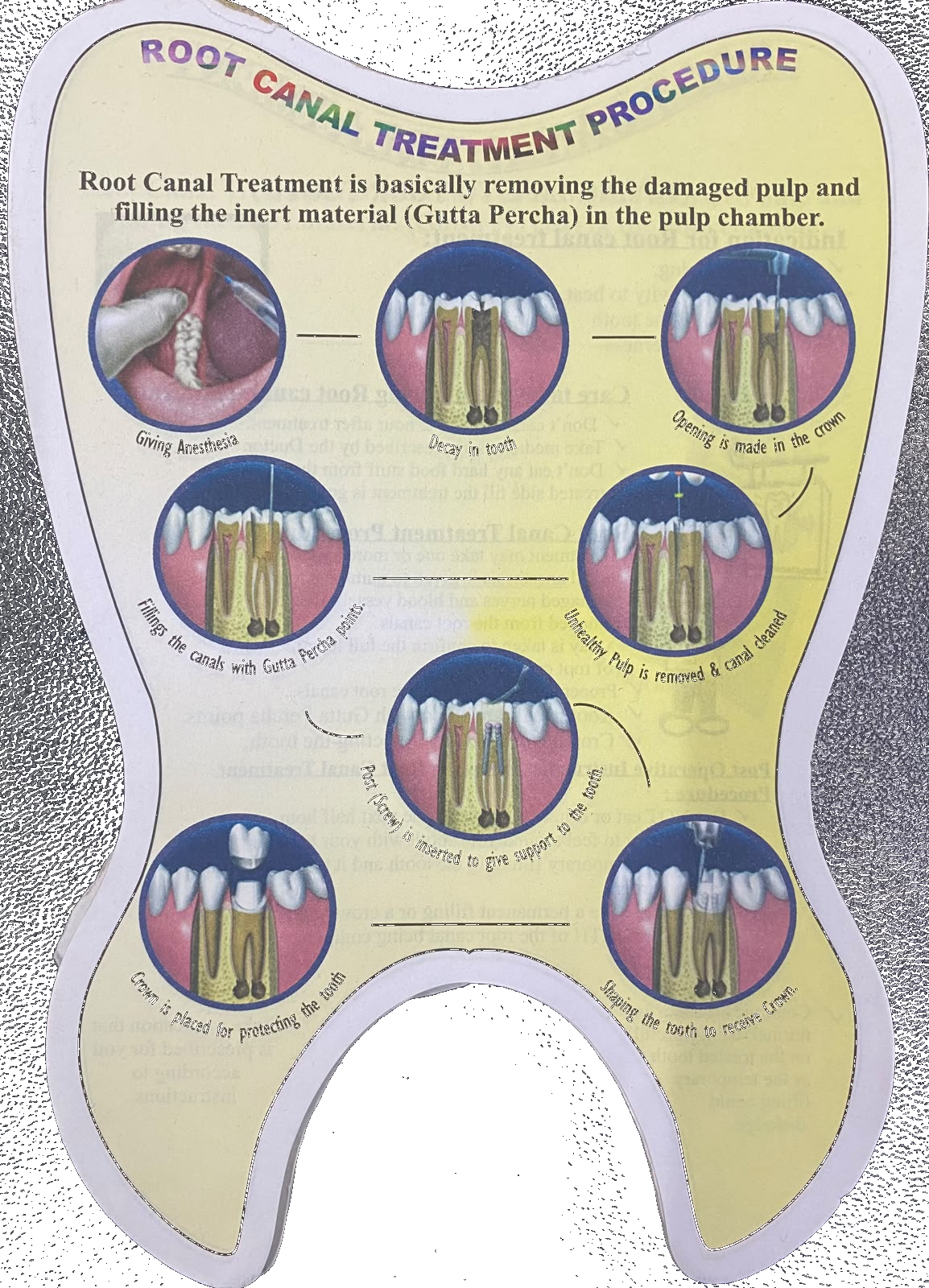 Tooth-shaped visual guide showing the root canal treatment procedure step by step