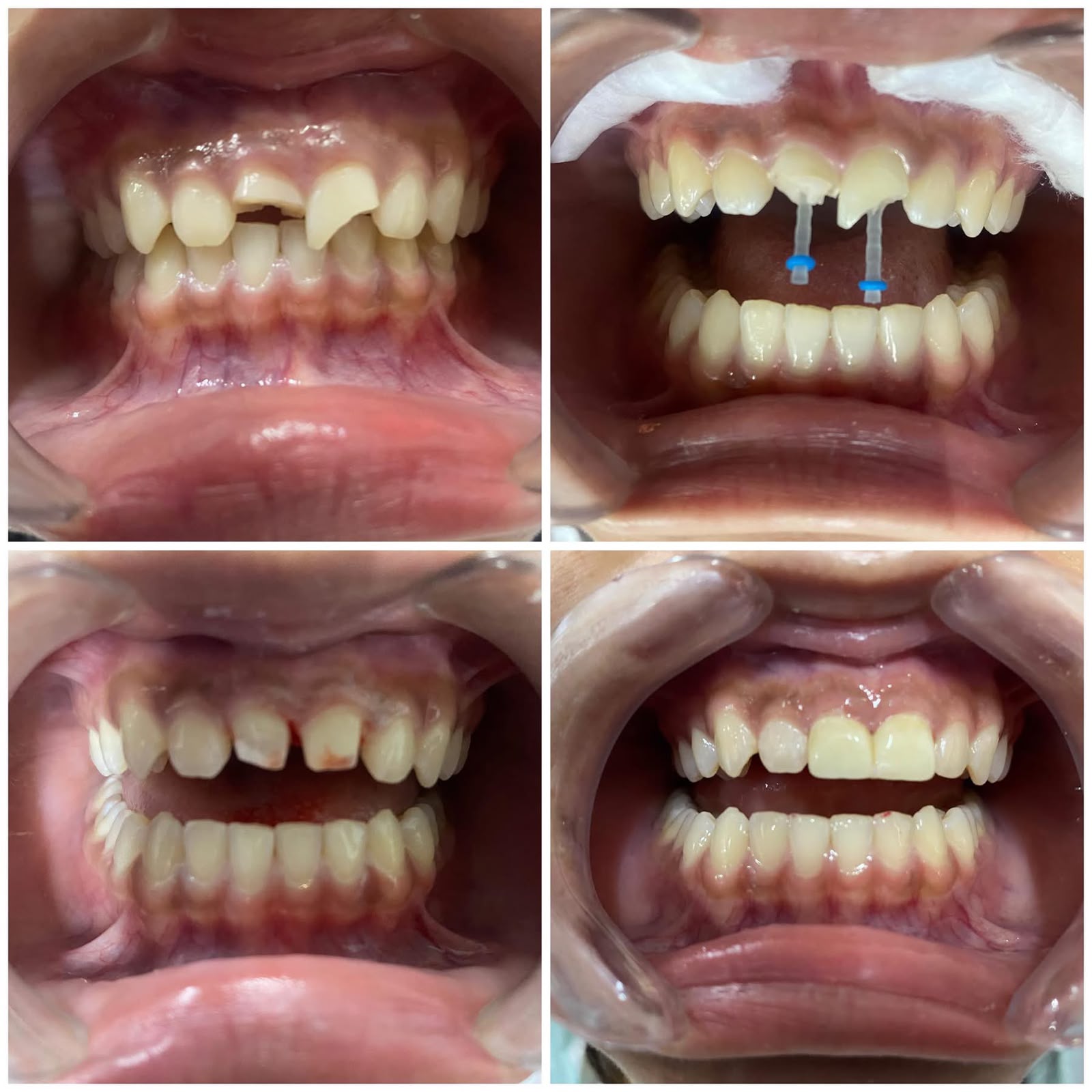 Before-and-after images of dental implant and prosthetics procedure